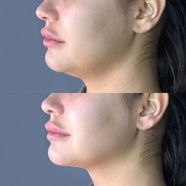 Kybella/Deso Face